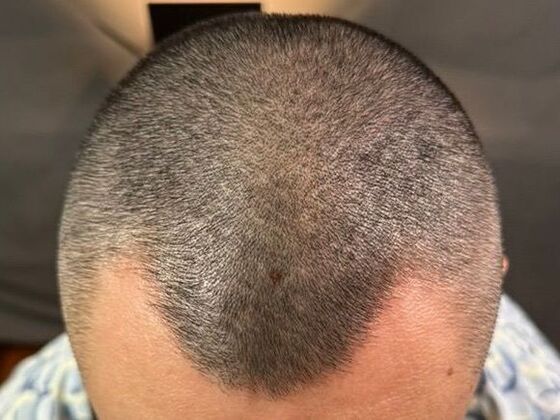 Hair Transplant Results Case 7 - Before