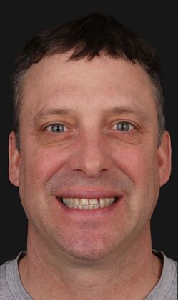 Full Mouth Restoration Gary  - Before