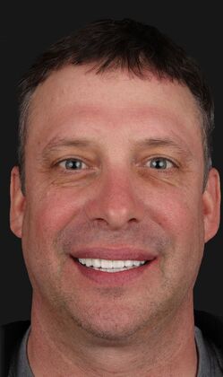 Full Mouth Restoration Gary  - After