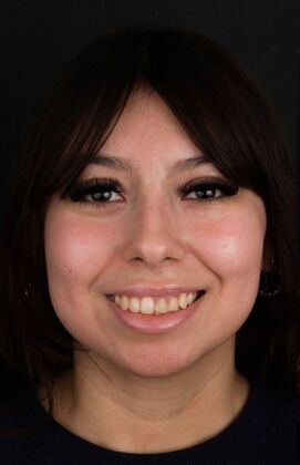 Porcelain Veneers Candy  - Before