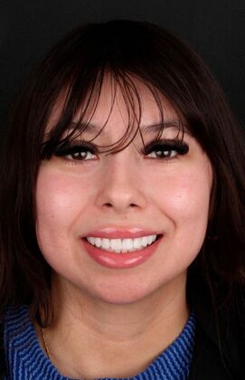 Porcelain Veneers Candy  - After