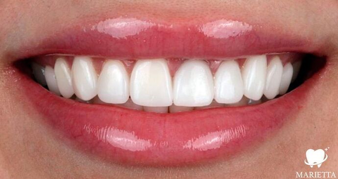 Porcelain Veneers: Candy - After