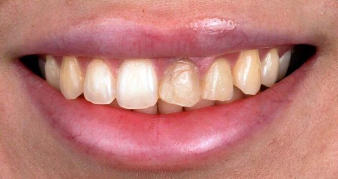 Porcelain Veneers: Candy - Before