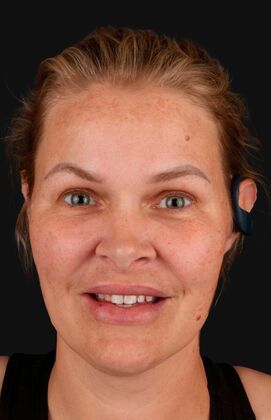 Full Mouth Restoration Beca - Before