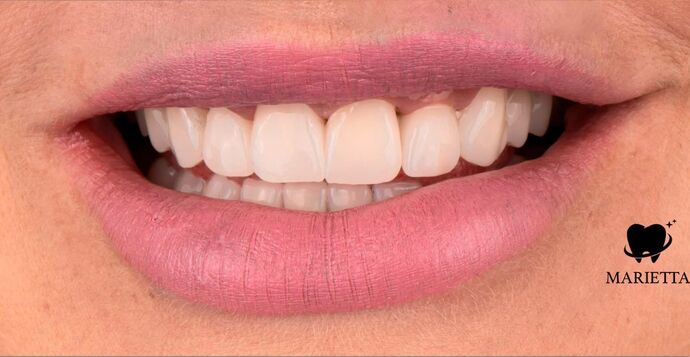 Full Mouth Restoration: Beca - After