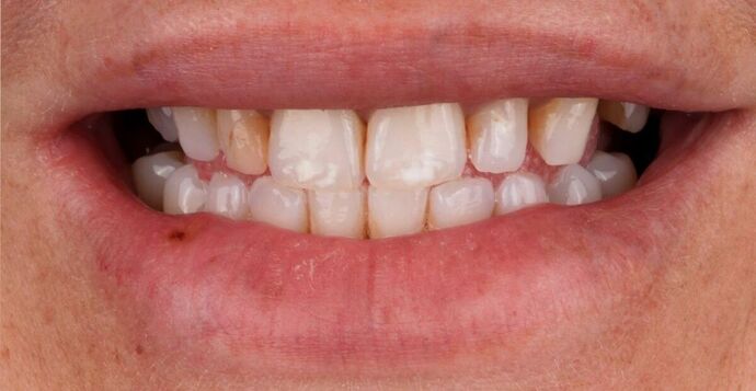 Full Mouth Restoration: Beca - Before