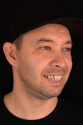 All-On-4/6: Charles - Before