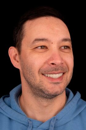 All-On-4/6: Charles - After