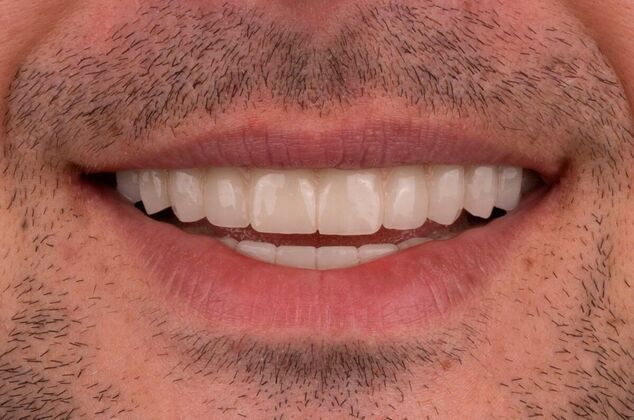 All-On-4/6: Charles - After