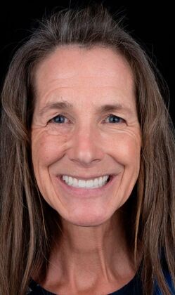 All-On-4/6: Laura - After