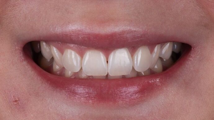 Smile Makeover & Veneers: Caitlin - Before