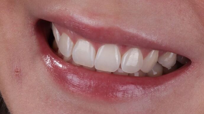 Smile Makeover & Veneers: Caitlin - Before