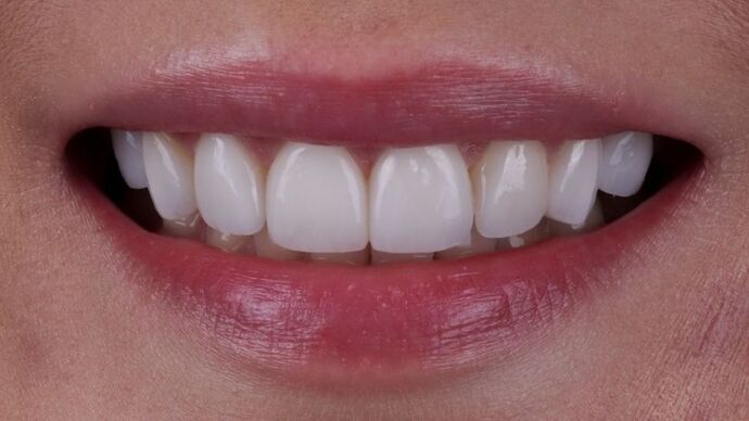 Smile Makeover & Veneers: Caitlin - After