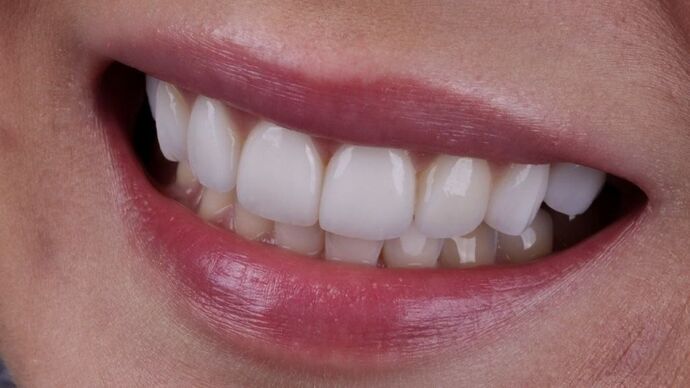 Smile Makeover & Veneers Caitlin