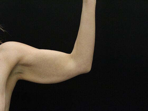 Arm Lift & Reduction: Case 17 - Before