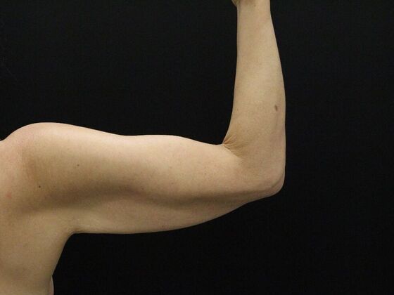 Arm Lift & Reduction Case 17 - Before