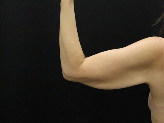 Arm Lift & Reduction: Case 17 - Before