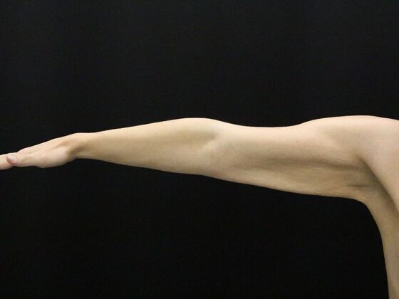 Arm Lift & Reduction: Case 17 - Before