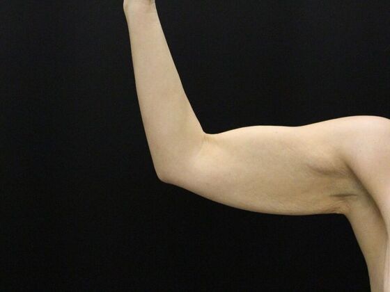 Arm Lift & Reduction: Case 17 - Before