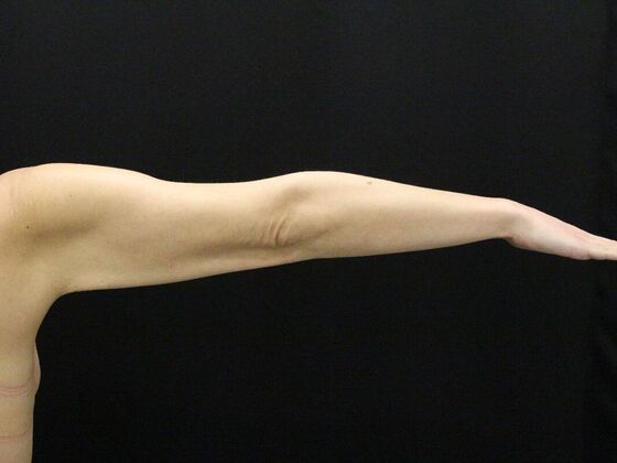 Arm Lift & Reduction: Case 17 - Before