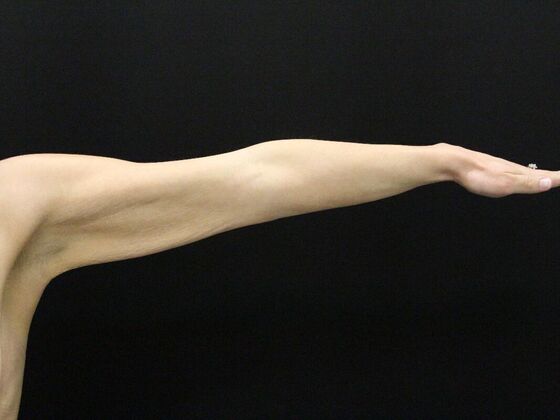 Arm Lift & Reduction: Case 17 - Before