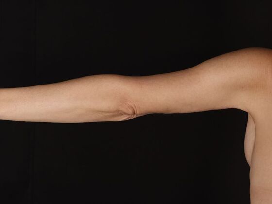 Arm Lift & Reduction: Case 17 - After