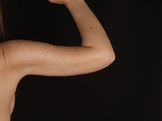 Arm Lift & Reduction Case 17 - After