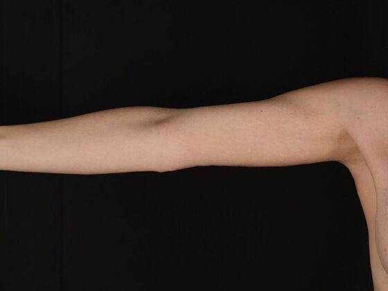 Arm Lift & Reduction: Case 17 - After