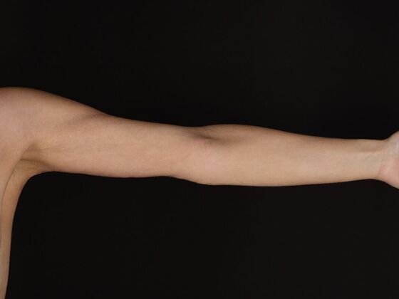 Arm Lift & Reduction: Case 17 - After