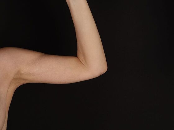 Arm Lift & Reduction: Case 17 - After