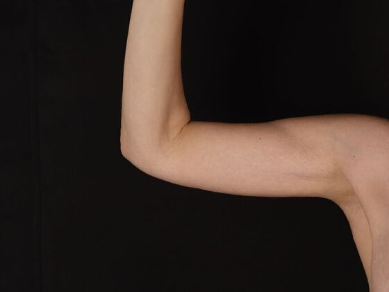 Arm Lift & Reduction: Case 17 - After