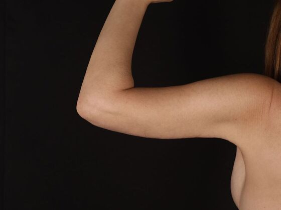 Arm Lift & Reduction: Case 17 - After