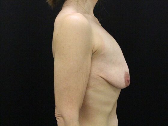 Breast Lift & Breast Lift Augmentation: Case 73 - Before