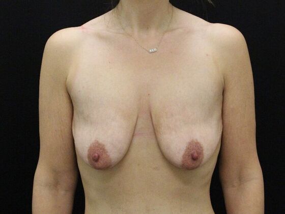 Breast Lift & Breast Lift Augmentation Case 73 - Before