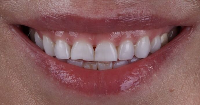 Smile Makeover & Veneers: Mary - Before
