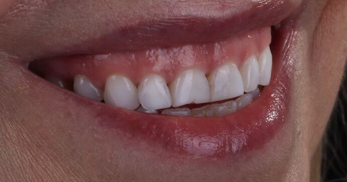 Smile Makeover & Veneers: Mary - Before