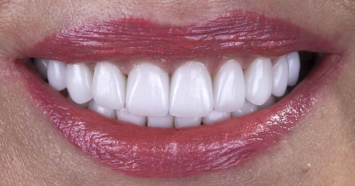 Smile Makeover & Veneers: Mary - After