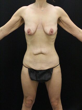 Tummy Tuck: Case 89 - Before