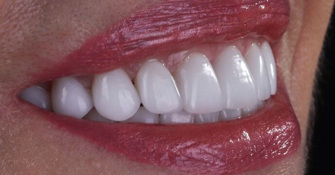 Smile Makeover & Veneers: Mary - After