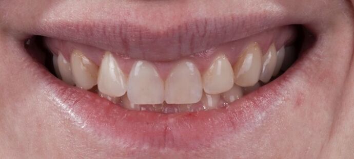 Smile Makeover & Veneers: Ginger - Before