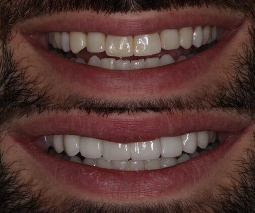 Veneers Case 1