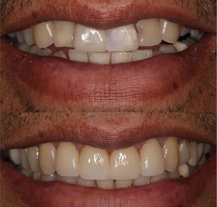 Veneers Case 2