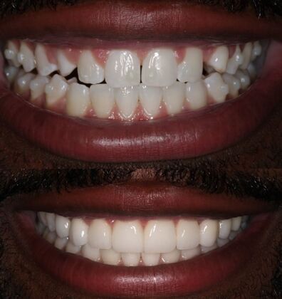 Veneers Case 3