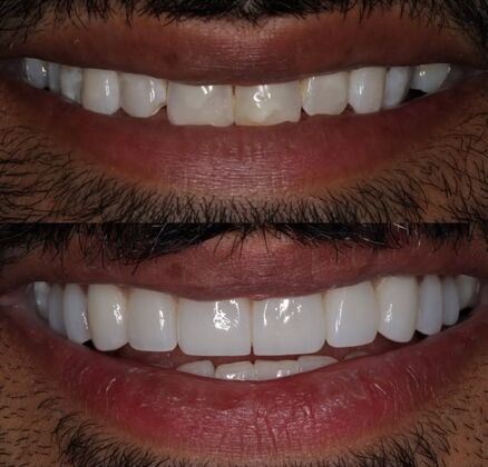 Veneers Case 4