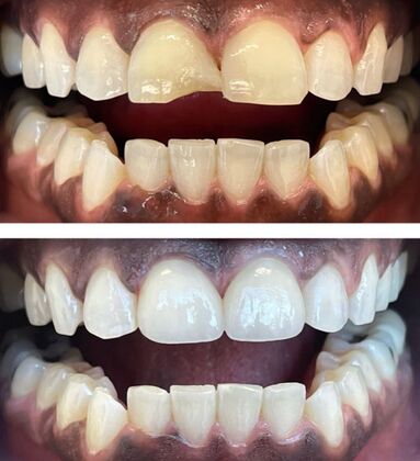 Veneers Case 5