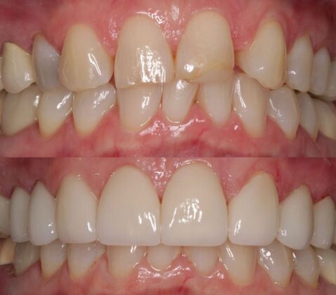 Veneers Case 6