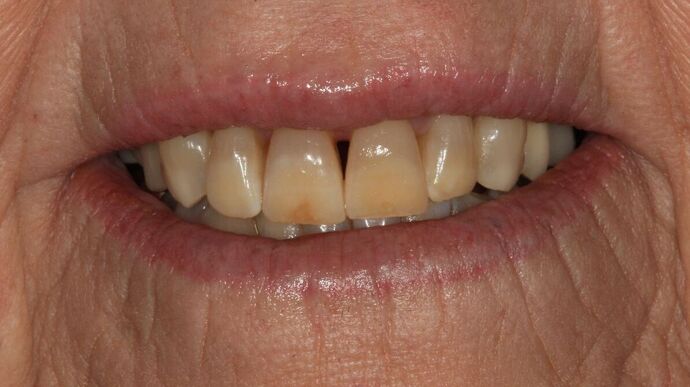 Full Mouth Reconstruction: Case 8 - Before