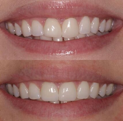 Veneers Case 7