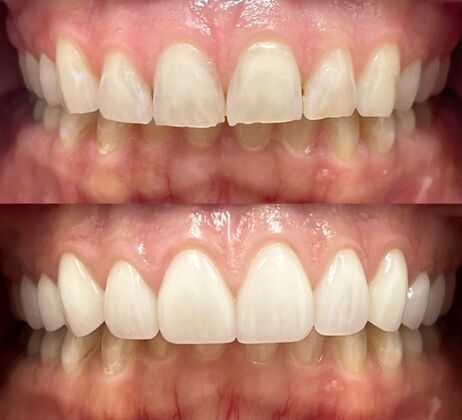 Veneers Case 8