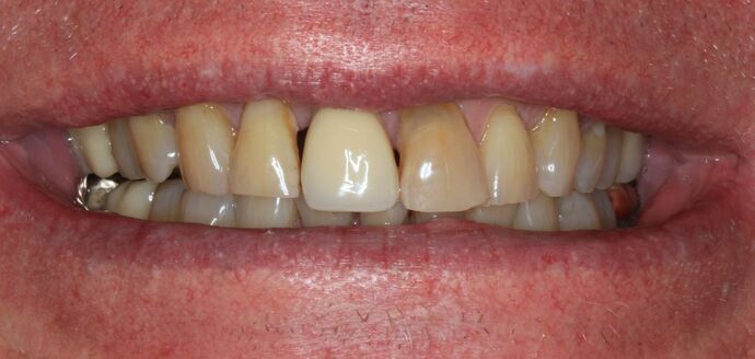 Full Mouth Reconstruction: Case 9 - Before